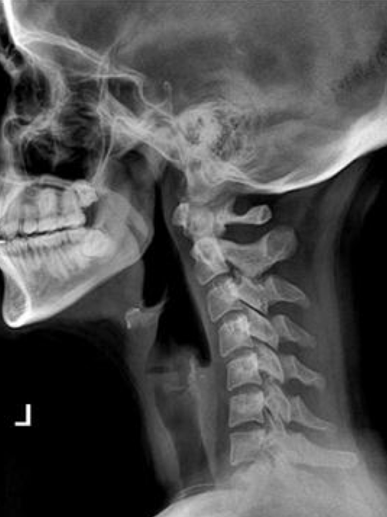Leher terlihat rata atau kyphosis (melengkung ke belakang)
